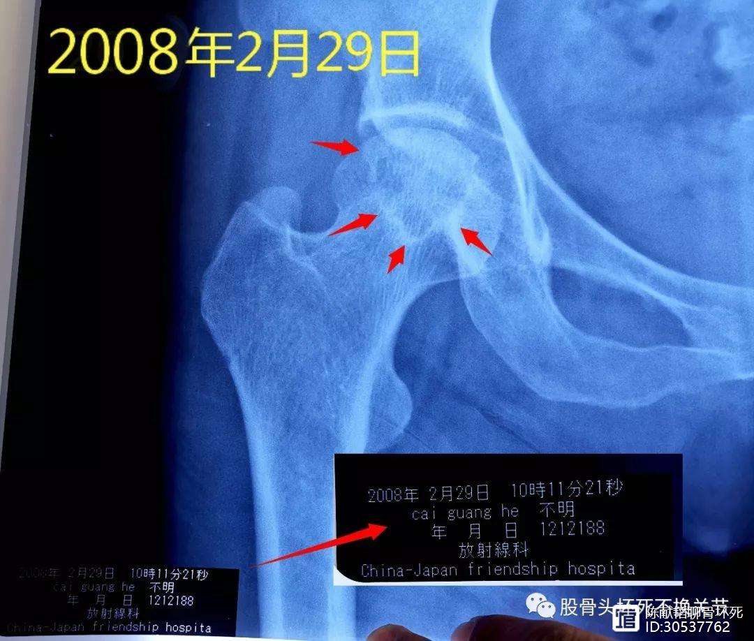 黄山人工骨头医保报销多少(人工骨头医保报销多少比例)